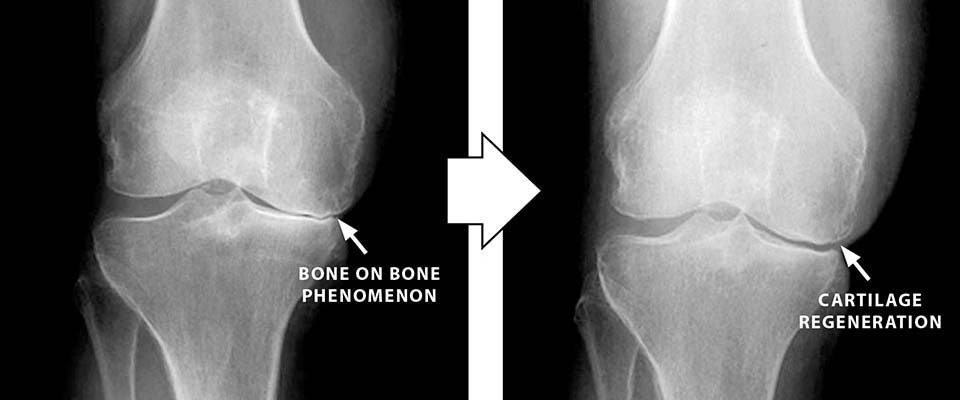 膝の痛みに再生医療