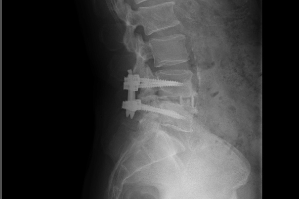 脊柱菅狭窄症の手術